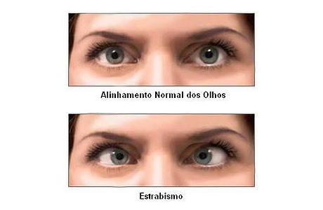 Estrabismo