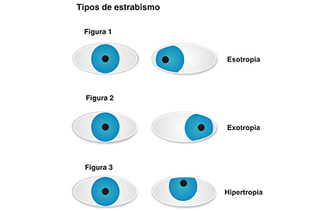 Estrabismo